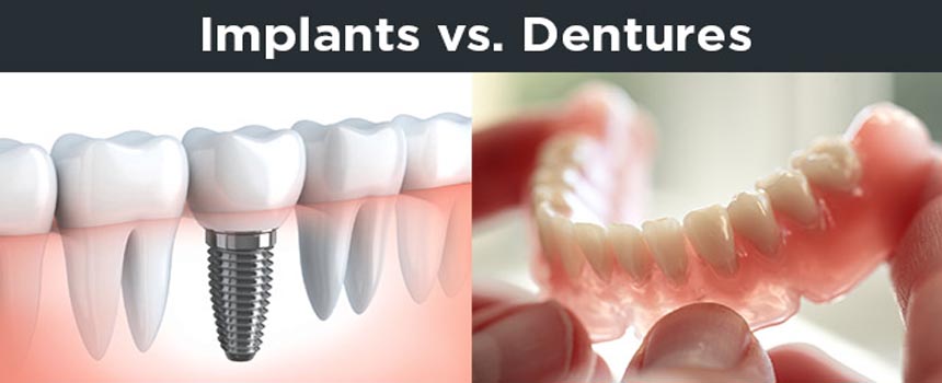 Denture Vs Implant in rohini sector 15, Delhi